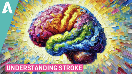 Understanding Stroke