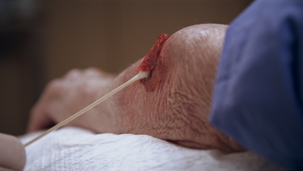 Wound Care: Skin Tears