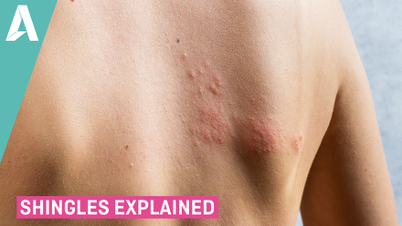 Shingles Explained